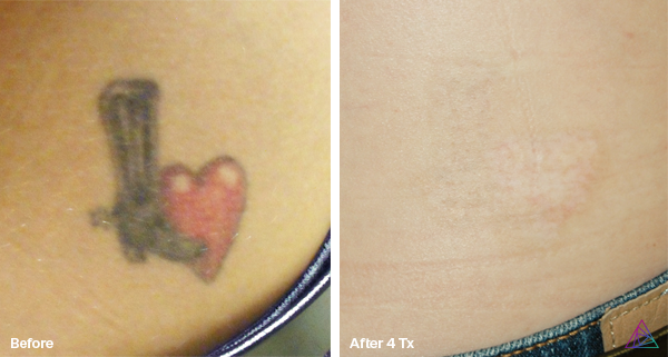 Before and after tattoo removal